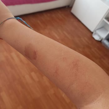 Epi Center Güzellik Lazer İşlemi Sırasında Vücudumu Yaktı