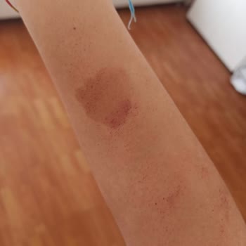 Epi Center Güzellik Lazer İşlemi Sırasında Vücudumu Yaktı