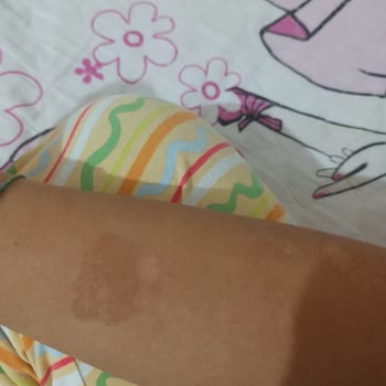 Epi Center Güzellik Lazer İşlemi Sırasında Vücudumu Yaktı