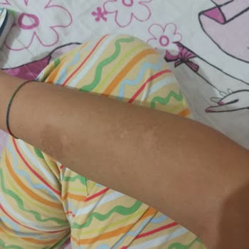 Epi Center Güzellik Lazer İşlemi Sırasında Vücudumu Yaktı