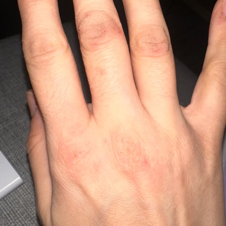 Sleepy Temizlik Havlusu Egzama Yapıyor!