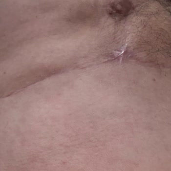 Ameliyat Sonrası İlgisizlik Ve Revizyon Sorunu