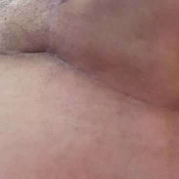 Ameliyat Sonrası İlgisizlik Ve Revizyon Sorunu