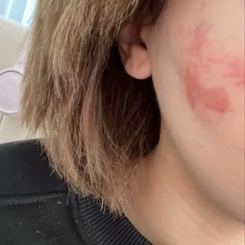 Bee Beauty Cilt Maskesi Yanığı: Acil Yardım Bekliyorum