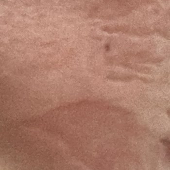 Bee Beauty Cilt Maskesi Yanığı: Acil Yardım Bekliyorum