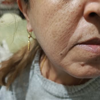 Züleyha Yeşilbaş Güzellik Salonu Cildimde Oluşan İzler