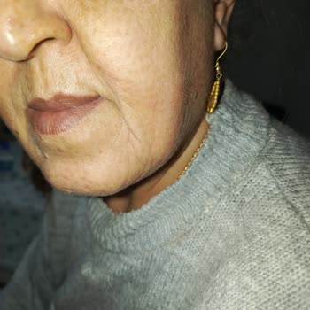 Züleyha Yeşilbaş Güzellik Salonu Cildimde Oluşan İzler