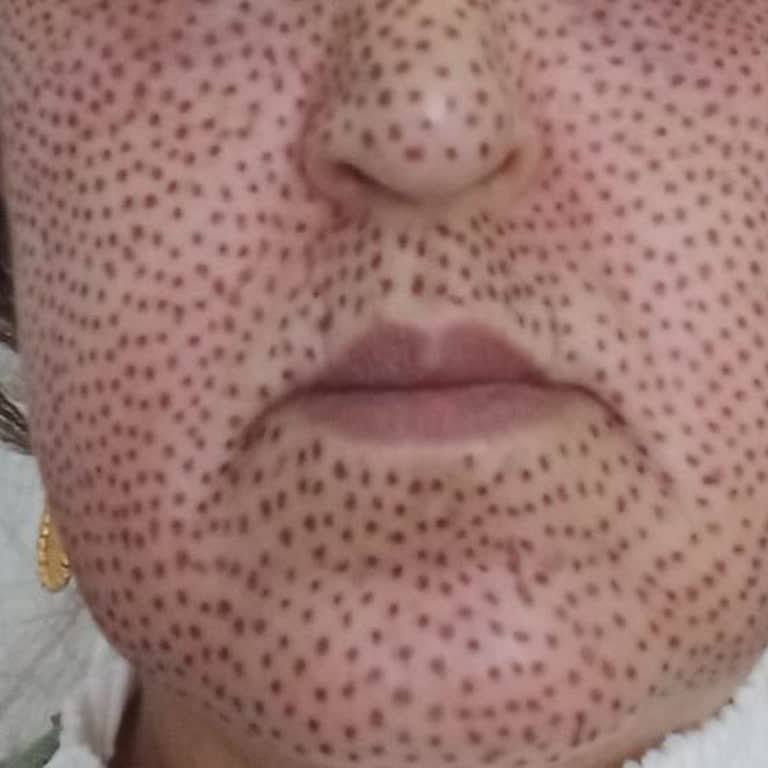 Züleyha Yeşilbaş Güzellik Salonu Cildimde Oluşan İzler