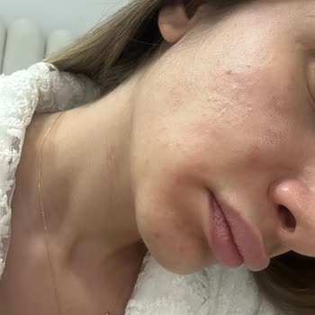 C Vitamini Ürünü Cildimde Tahrişe Yol Açtı