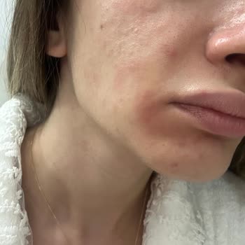 C Vitamini Ürünü Cildimde Tahrişe Yol Açtı