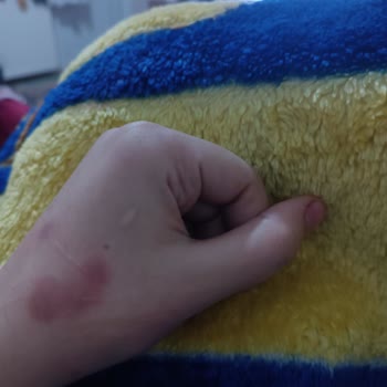 Dove Deodorant Cildimde Yanık Oluşturdu!