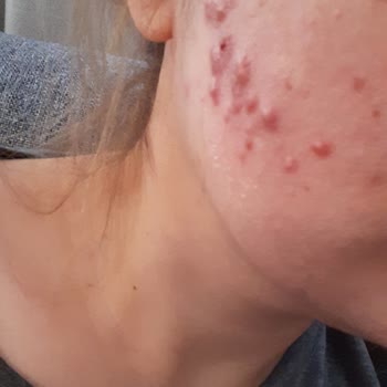 Kırmızı Peeling İle Gelen Cilt Sorunları
