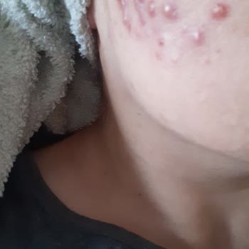 Kırmızı Peeling İle Gelen Cilt Sorunları