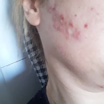 Kırmızı Peeling İle Gelen Cilt Sorunları