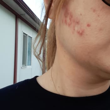 Kırmızı Peeling İle Gelen Cilt Sorunları