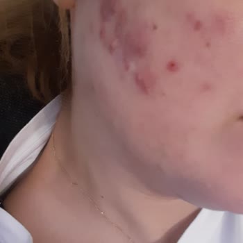 Kırmızı Peeling İle Gelen Cilt Sorunları