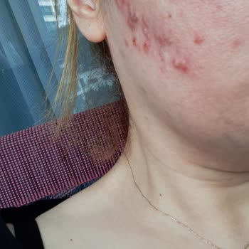 Kırmızı Peeling İle Gelen Cilt Sorunları