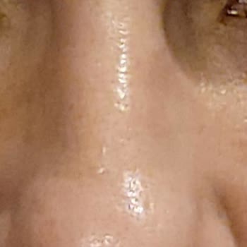 Göz Altı Mezoterapi Sonrası Beklenmedik Şişlik Ve Morluk