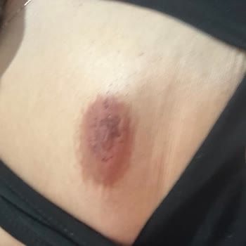 Veet Tüy Dökücü Krem Yanığı