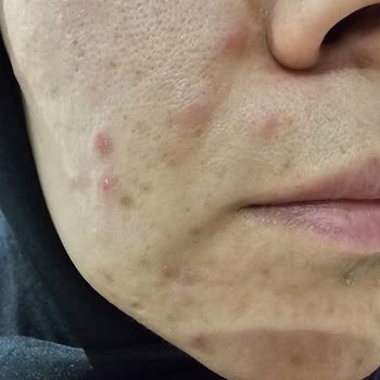 Nemlendirici Krem Cilt Sorunlarına Yol Açıyor