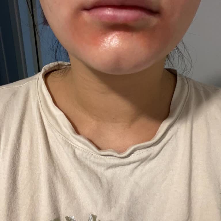 C Vitamini Serumu Yüzümü Yaktı: Mağduriyetim Ve Hayal Kırıklığım