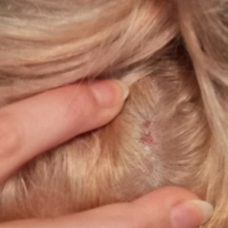 Palette 10.1 Saç Boyası Kullanımı Sonrası Ciddi Yanık Problemi