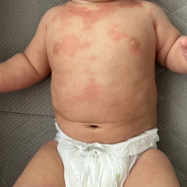 Bebek Yağı Kullanımı Sonrası Alerjik Reaksiyon