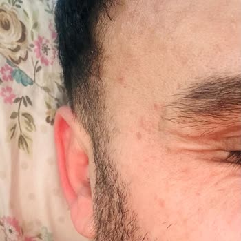 Siempre Belleza Güzellik & Bakım Merkezi Botoks Ve Dolgu İşlemlerinde Hayal Kırıklığı!