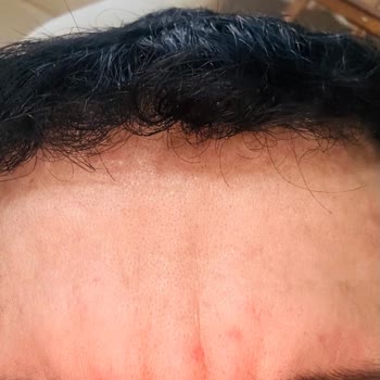 Siempre Belleza Güzellik & Bakım Merkezi Botoks Ve Dolgu İşlemlerinde Hayal Kırıklığı!