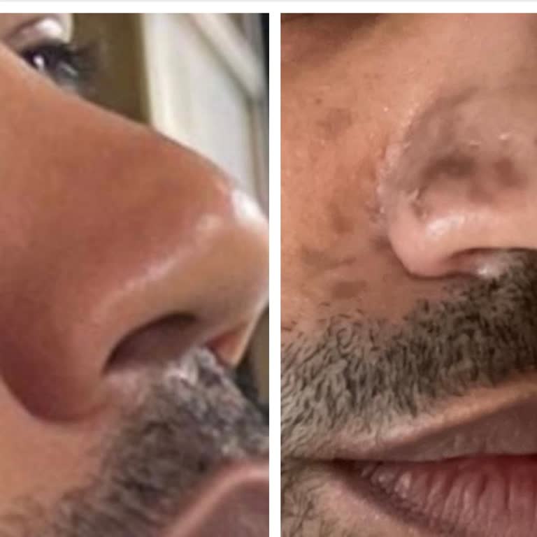 Hydrafacial Tedavisinde Büyük Hayal Kırıklığı