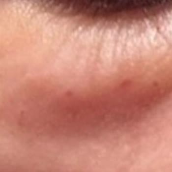 Ed Clinique Göz Altı Mezoterapisi: Profesyonellikten Uzak Bir Deneyim!