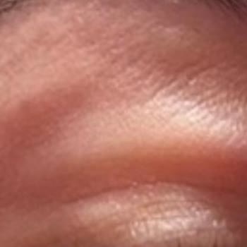 Ed Clinique Göz Altı Mezoterapisi: Profesyonellikten Uzak Bir Deneyim!