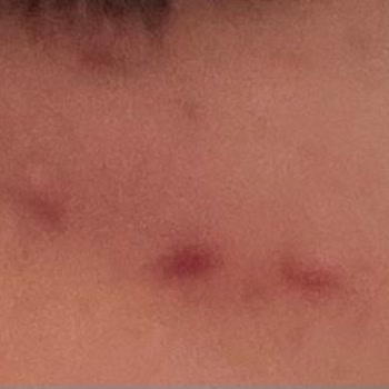 Ed Clinique Göz Altı Mezoterapisi: Profesyonellikten Uzak Bir Deneyim!