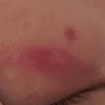 Ed Clinique Göz Altı Mezoterapisi: Profesyonellikten Uzak Bir Deneyim!