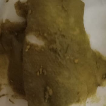 Sma Ar İle Kızımın Sağlık Sorunları Artıyor