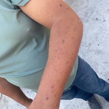 Epilasyon Hizmetinde Sorumluluk Alınmıyor