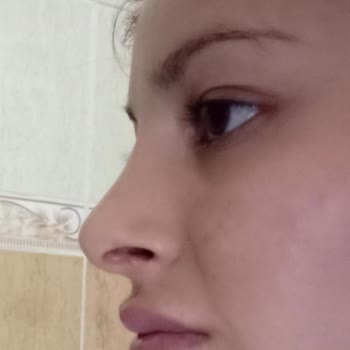 Rinoplasti Sonrası Hayal Kırıklığı Ve İletişim Sorunları