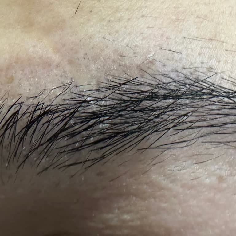 Benefit Brow Setter Caused Irritation, Flaking, and Hair Loss