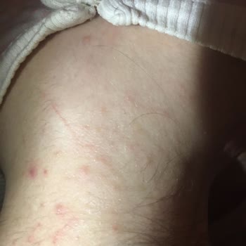 Bioblas Saç Kremi Alerji Sorunu