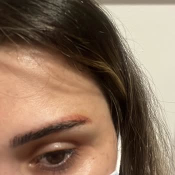 Dövme Silme Deneyiminde Hayal Kırıklığı