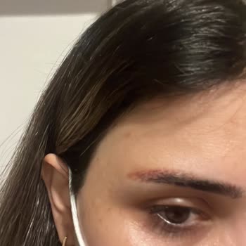 Dövme Silme Deneyiminde Hayal Kırıklığı