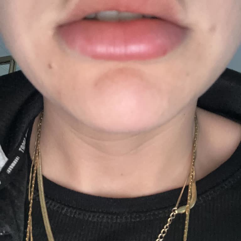 Sağlık Bakanlığına Bağlı Hastanede Alerjik Reaksiyon Riski