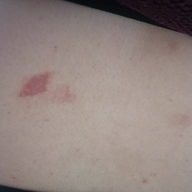 Lazer Tedavisinde Yanık Ve İlgisizlik