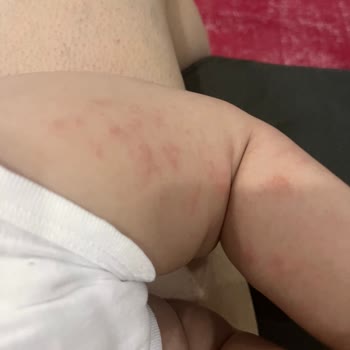 Mustela Ürünleri Kızarıklık Sorunu Yarattı