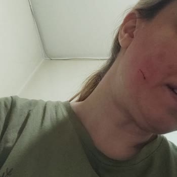 Cam Ocak Patlamasıyla Gelen Tehlike