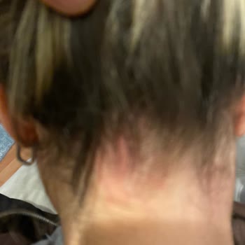 Bioxin Şampuan Egzama Ve Kaşıntıya Sebep Oldu