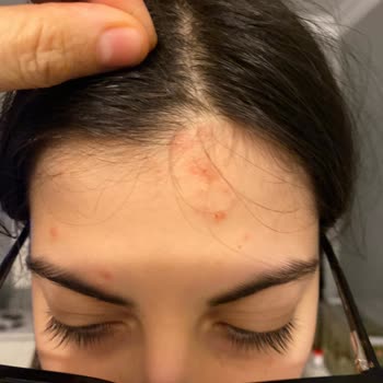 Bioxin Şampuan Egzama Ve Kaşıntıya Sebep Oldu