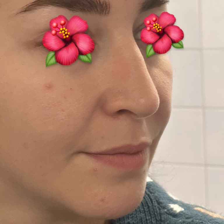 Revizyon Ameliyatı Sonrası Hayal Kırıklığı Ve İletişim Sorunları