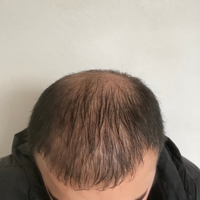 Saç Ekimi Sonuçlarından Memnuniyetsizlik Ve Revizyon Beklentisi