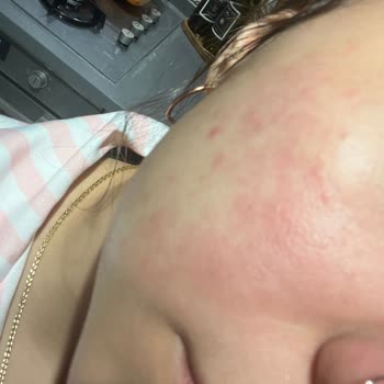 Yves Rocher Nemlendirici Yüzümde Yanma Ve Kızarıklık Yaptı